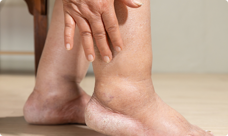 Close-up of a person's foot with visible veins, holding their ankle.