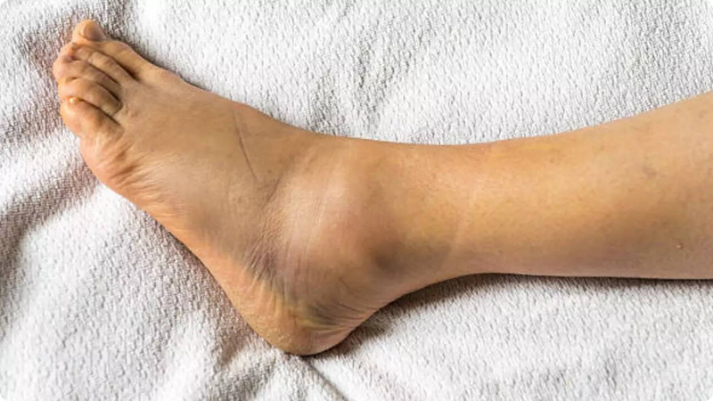 Foot with a visible corn on a white towel